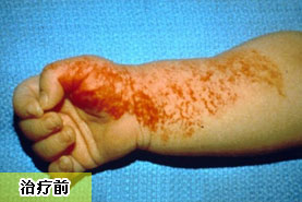 新生兒習慣性流產