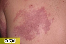 大面積治療血管胎記