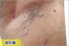 腿部產后漏尿擴張