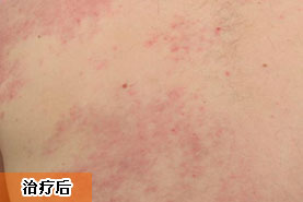 大面積治療血管胎記