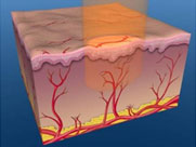 治療不產生紫癜