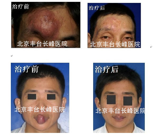 動(dòng)靜脈男科治療前后圖片對(duì)比