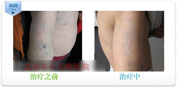 動(dòng)靜脈血管畸形